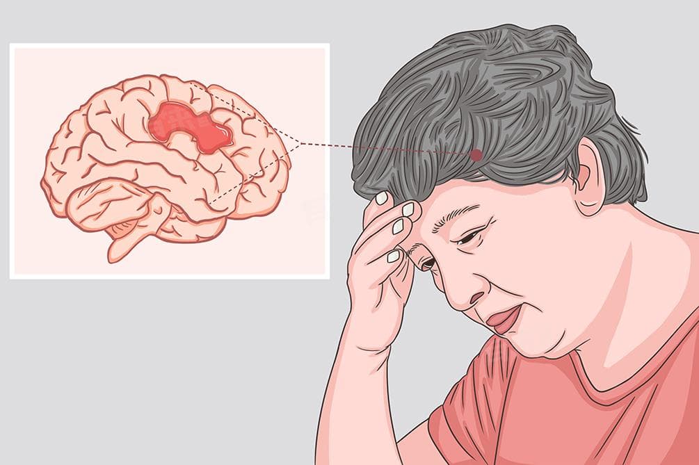 什么叫卒中？一文读懂这种高发脑血管疾病