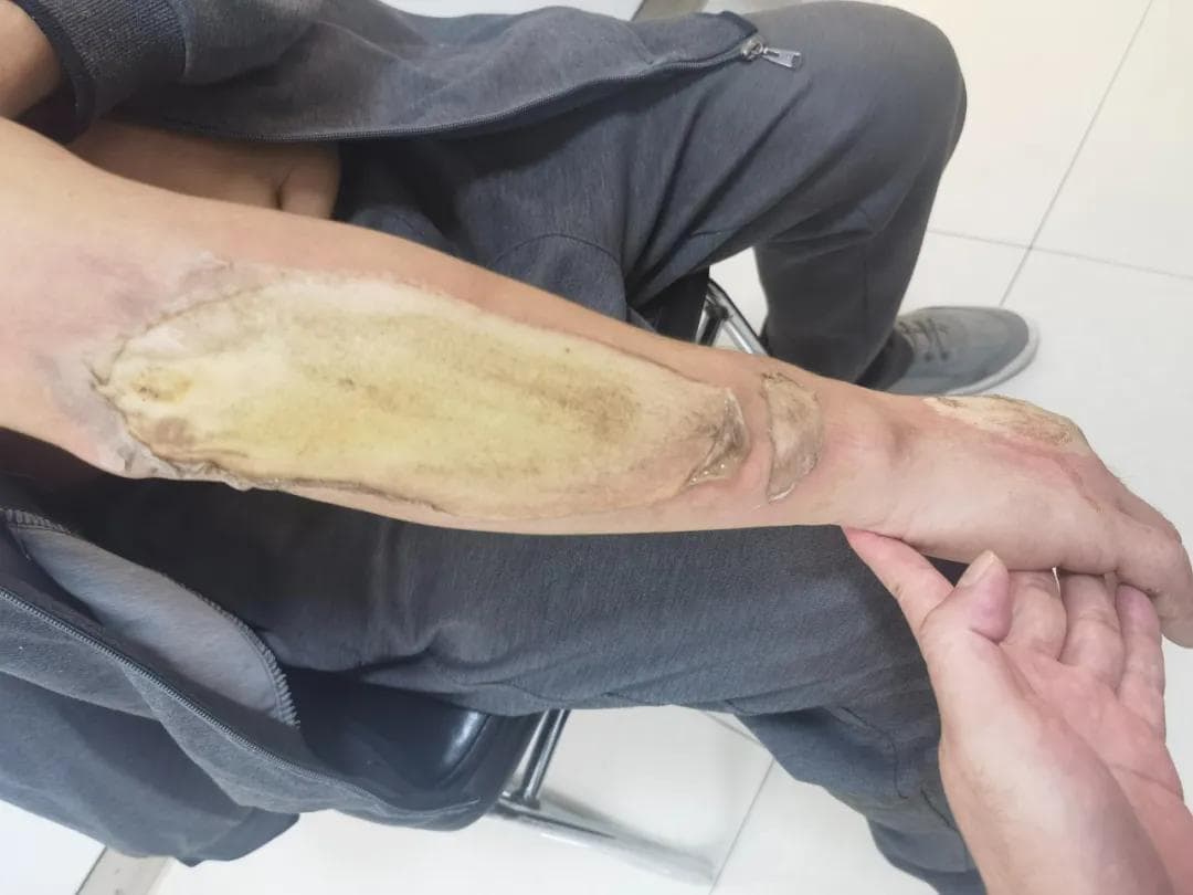 烫伤了千万不能涂酱油，也不能涂牙膏！正确的做法是...