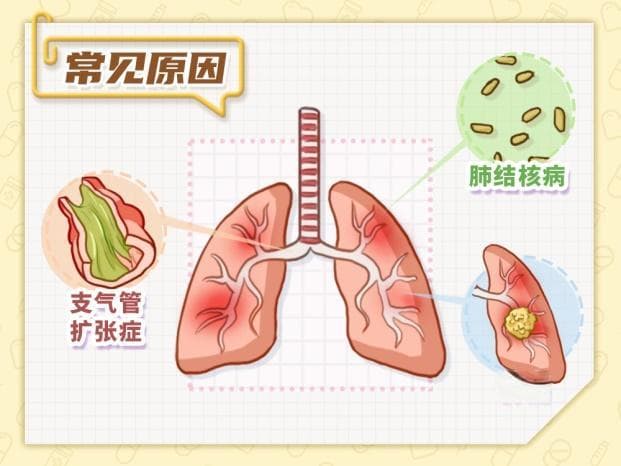 咯血就是肺结核吗？需要做什么检查？