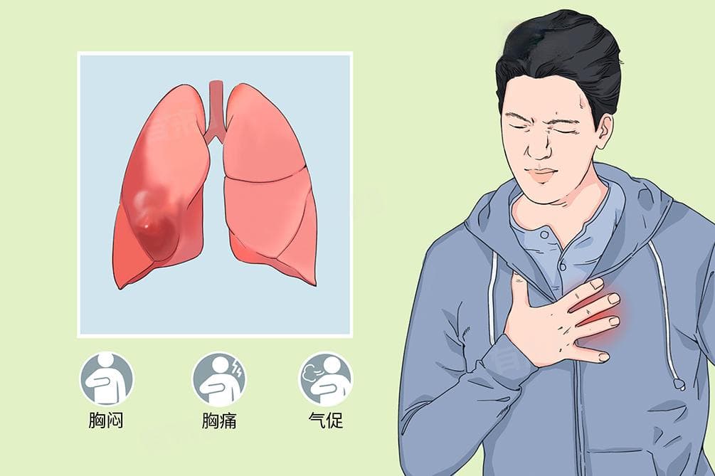 肺大泡算不算大病
