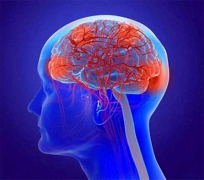 国产脑梗新药问世，能帮患者恢复自理，可老百姓吃得起吗？