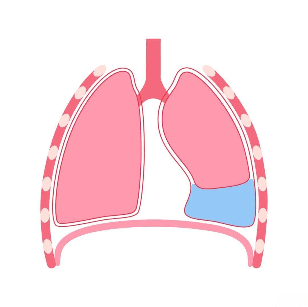 胸腔积液敲响健康警钟，这些隐藏病因你知道多少？