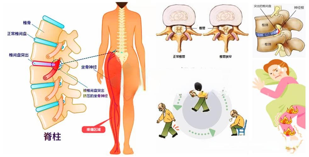 腰椎间盘突出：CT 检查轻，但症状重，这是怎么回事？