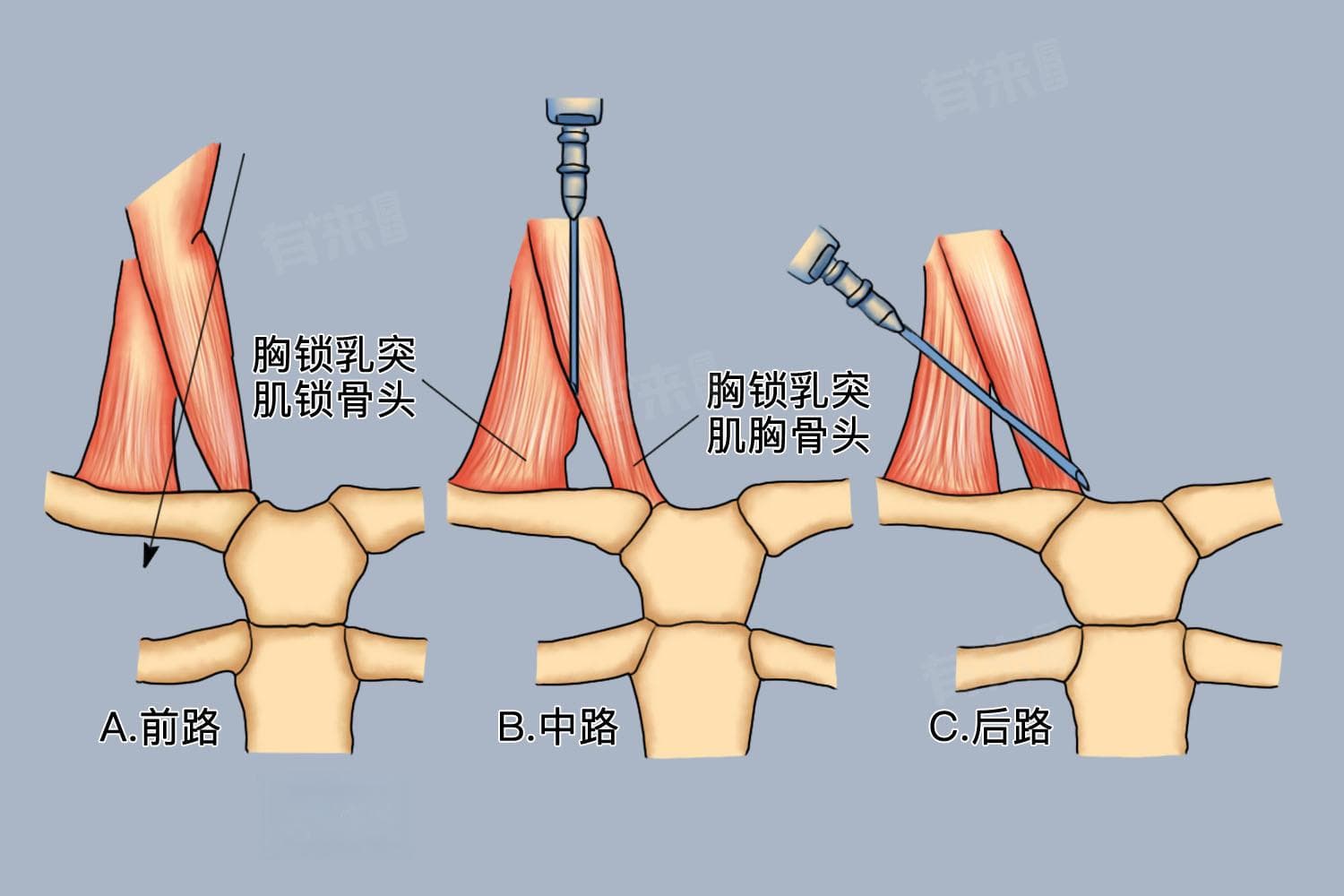 TIPS医学上指什么