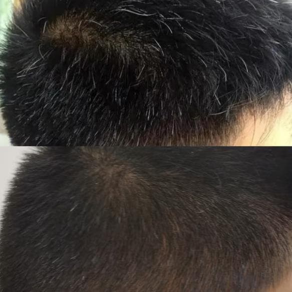 “少白发”试试中医治疗
