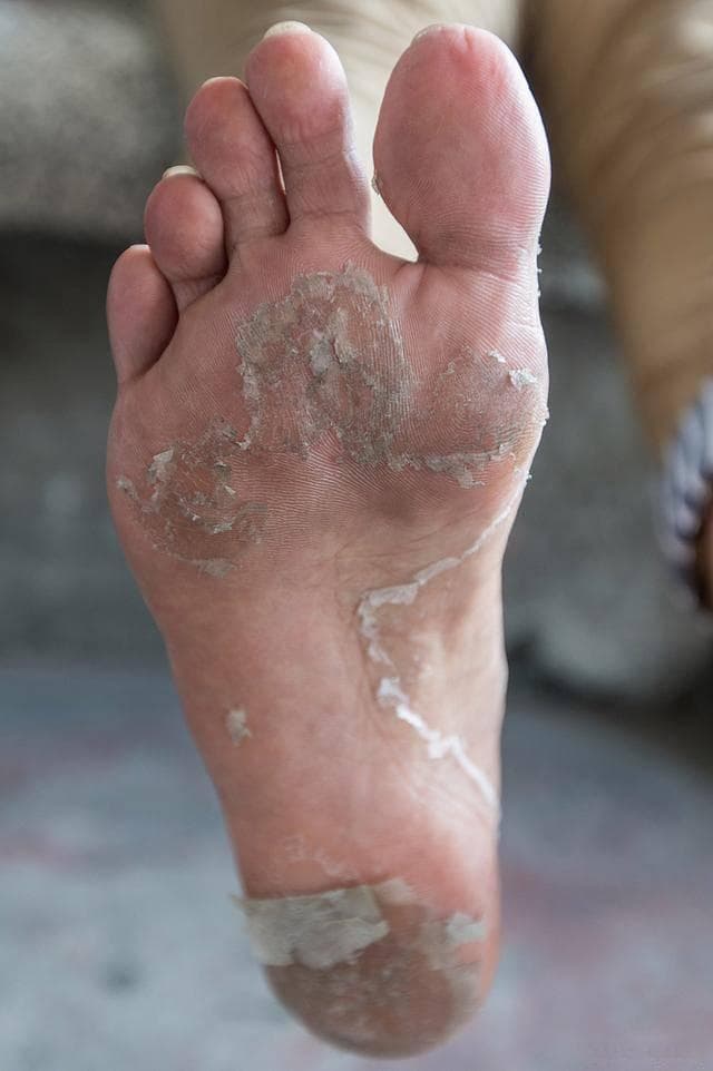 脚气真菌根除方法：医生分享三大技巧，彻底治愈不复发