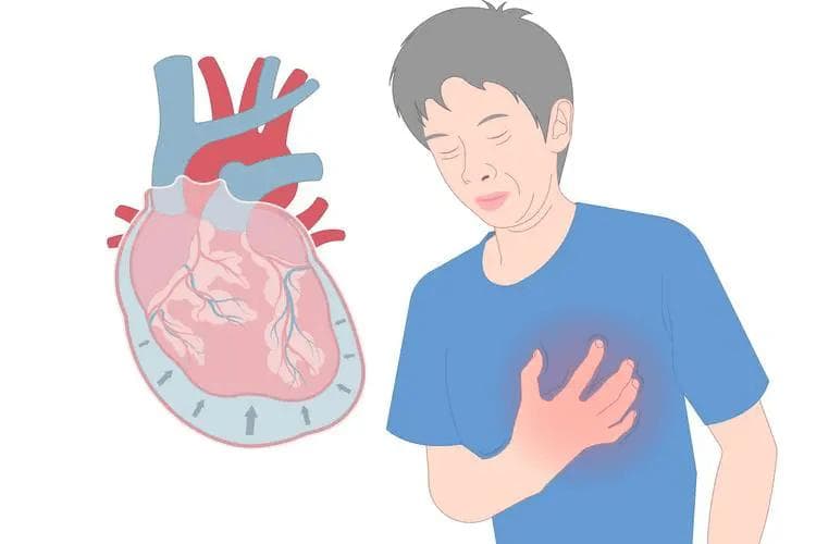 中医益气宣肺利水疗法治疗心包积液