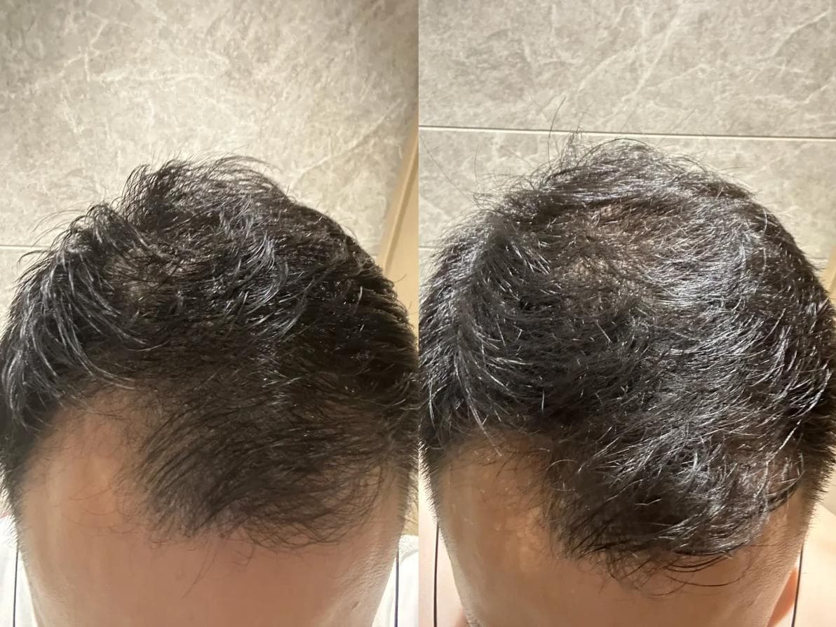 脱发与心理健康之间是否存在关联？