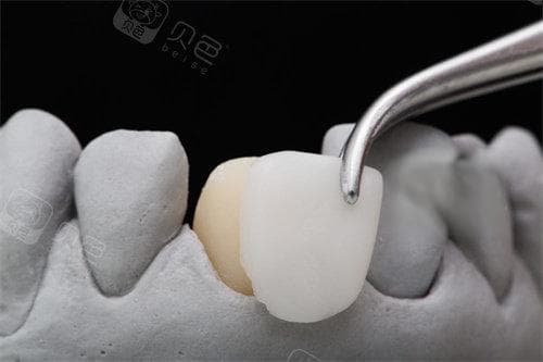 全瓷牙与树脂牙有什么区别？哪个更耐用？看完便了解