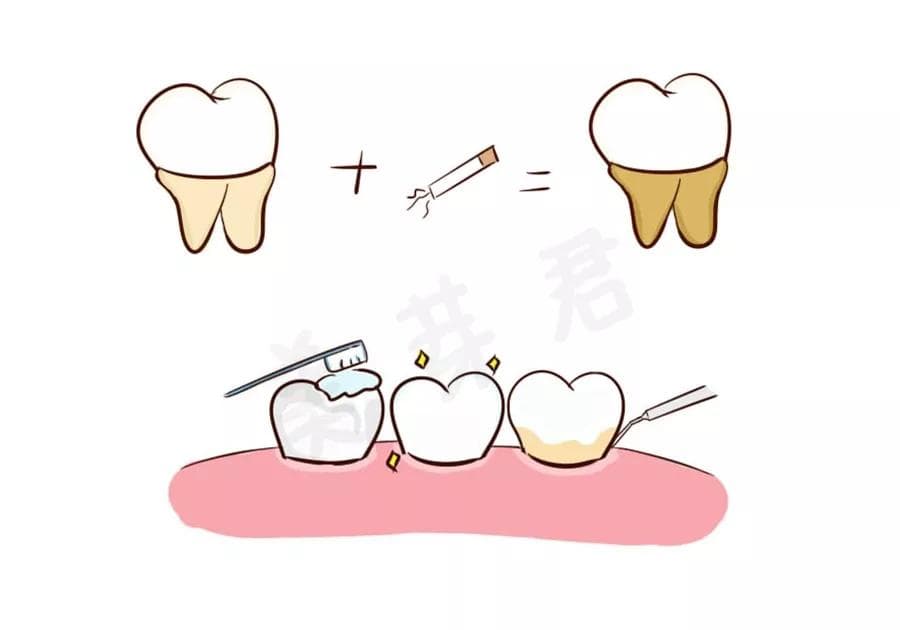 伢典科普洗牙全攻略：史上最全的洗牙介绍和问答集锦