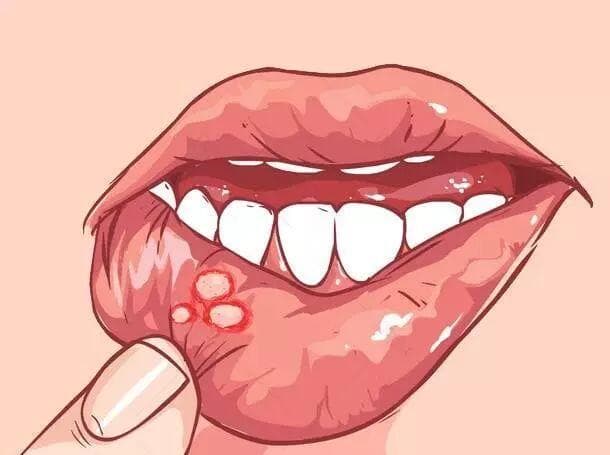 认识口腔溃疡：原因、症状与治疗