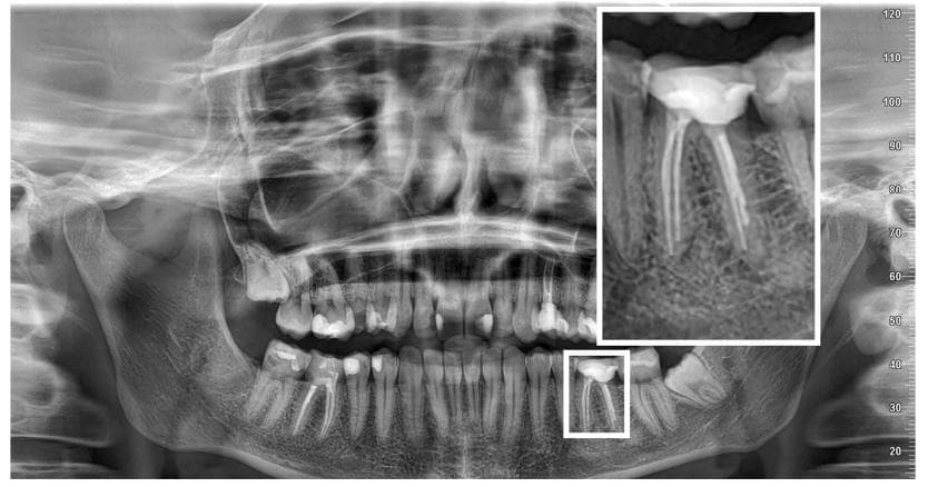 J Clin Med：人工智能在口腔影像学中诊断根尖周病变的准确性评估