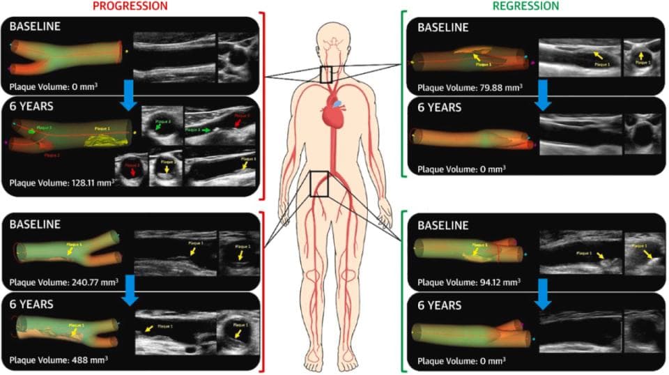 「动脉硬化斑块」竟可完全消退！JACC颠覆性大发现：这5件事必须做好