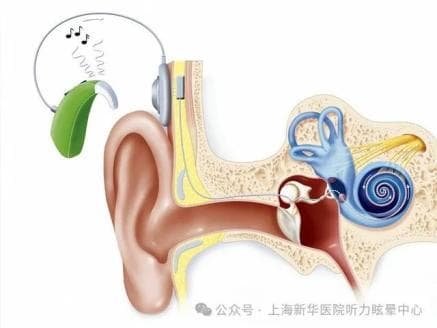 人工耳蜗使用的家庭指导