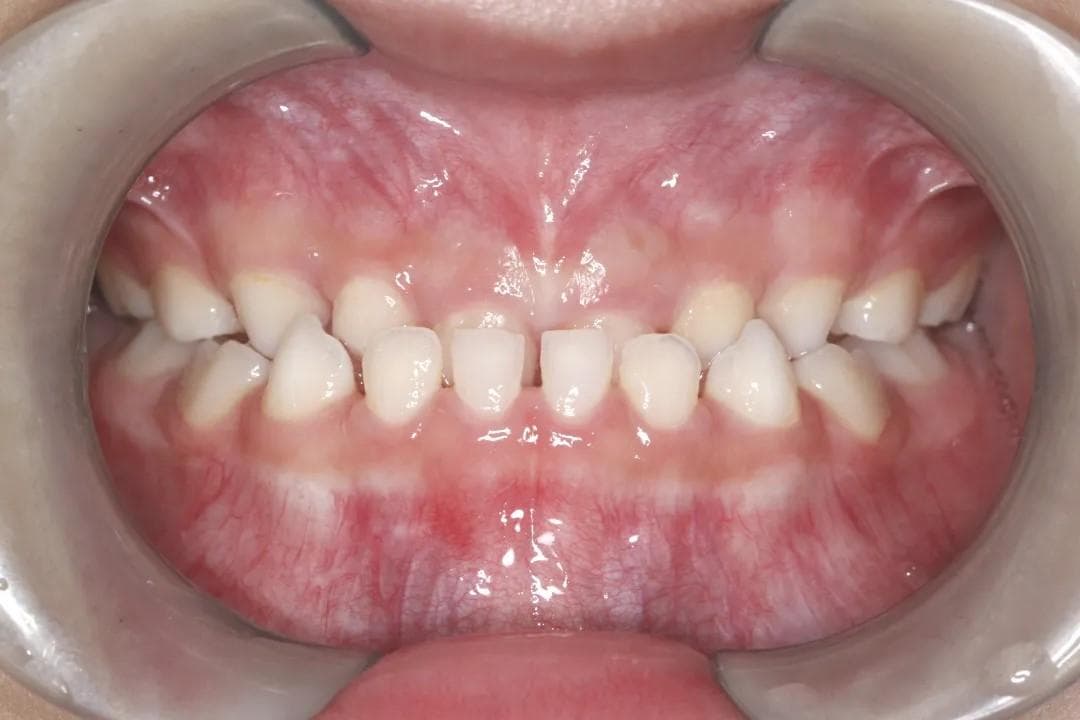 换完牙齿才能做矫正？小朋友牙齿矫正的三个黄金时期，各位家长别错过！