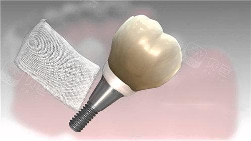 深度解读韩国登腾(Dentium)种植牙质量评价、质保年限及使用寿命探秘