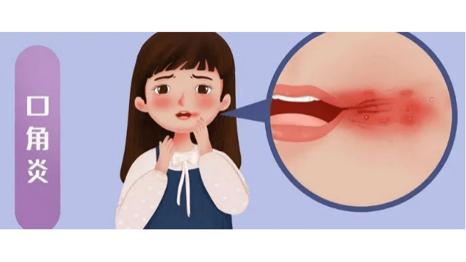 口腔黏膜疾病：不容忽视的口腔健康隐患