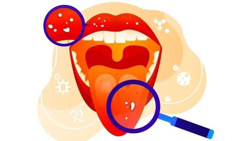 口腔溃疡是缺维生素？错！这样对症下药好得快，终结口腔溃疡！