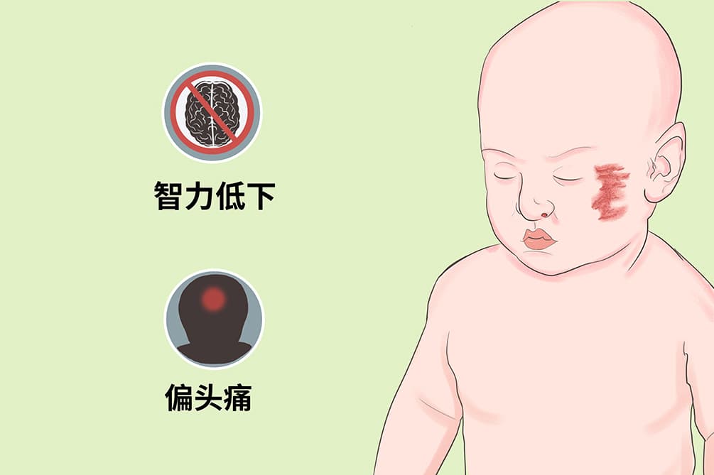 斯特奇-韦伯综合征