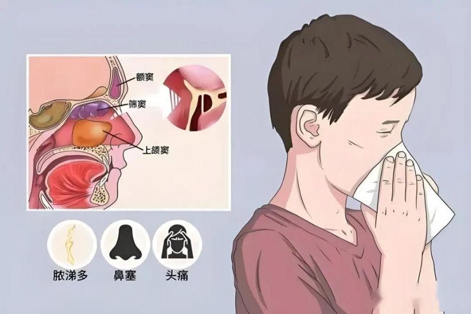 益生菌治疗慢性鼻窦炎的潜力