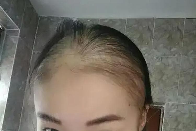 化疗掉头发解决方法