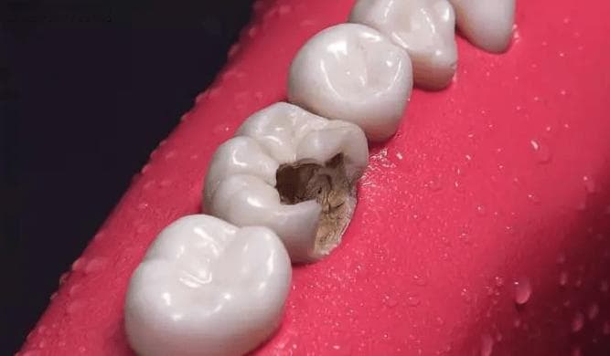 蛀牙疼了，可以保留牙髓不杀神经吗？