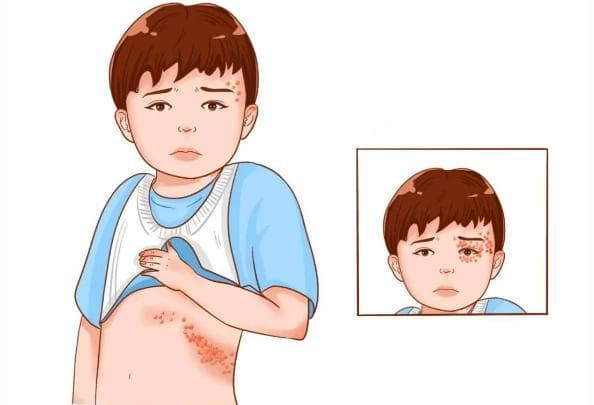 “蛇缠腰”了怎么办？带状疱疹的全面解析与防治指南
