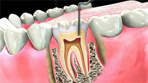 根管侧穿的补救方法：新鲜穿孔、陈旧性穿孔及不同部位穿孔的处理方案