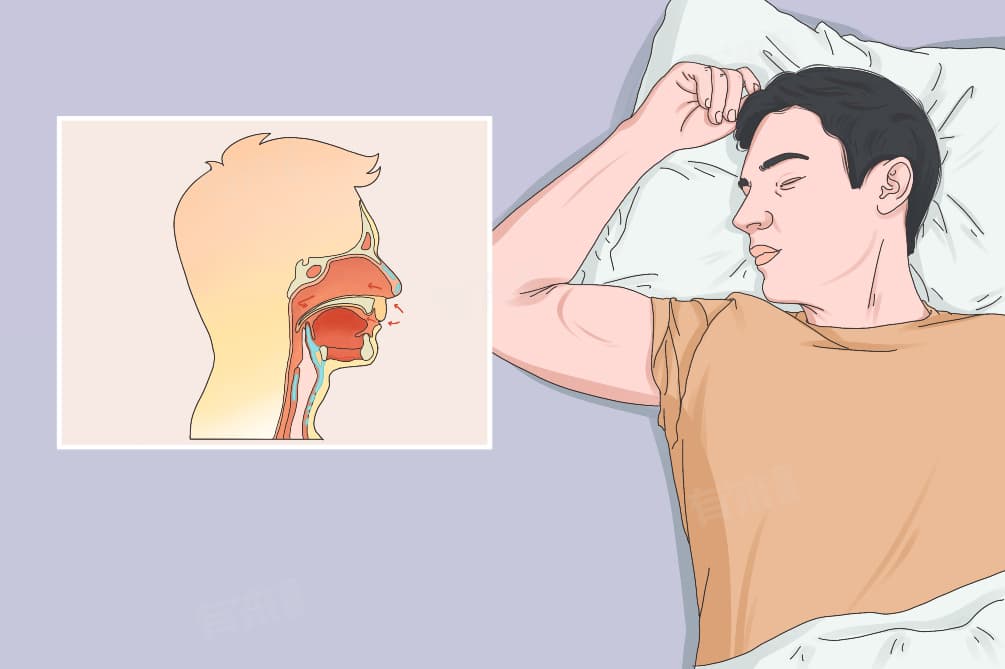 睡眠呼吸暂停综合征的症状与治疗方法