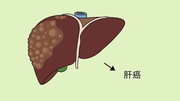 乙肝呈“三阳”，生活要注意！大小三阳患者，这3点可要做好了