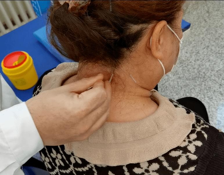【针灸】颈椎病一针疗法