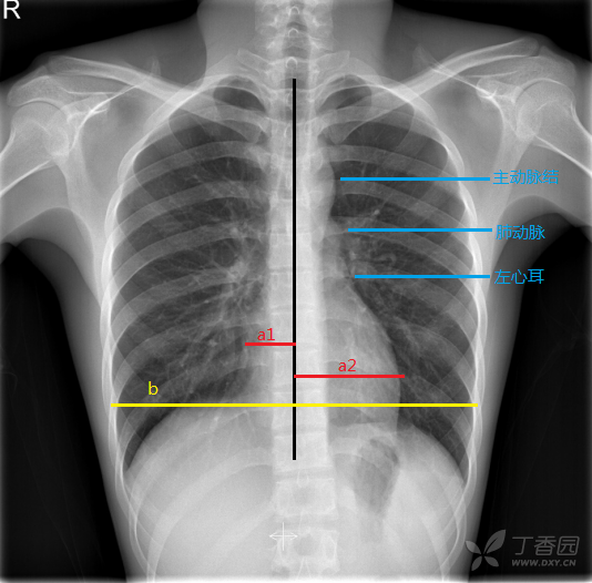 那些与心血管疾病密切相关的异常胸片征象