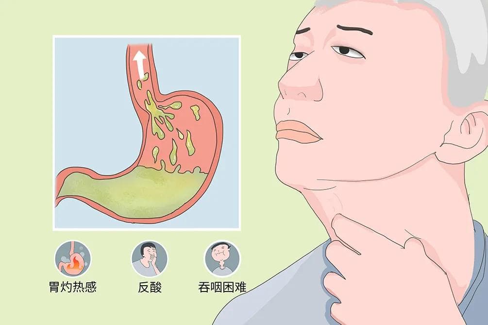 反流性食管炎