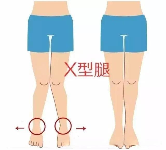X型腿形成的原因，导致的危害，以及如何调整