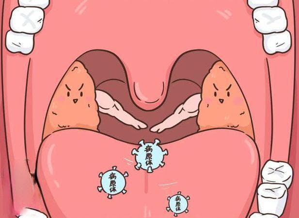 扁桃体炎真的是“小问题”吗？如何分辨普通咽喉疼痛与扁桃体炎