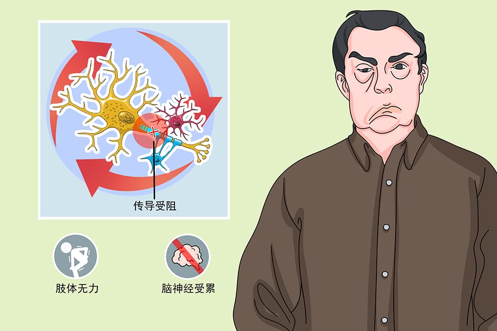 吉兰巴雷综合征
