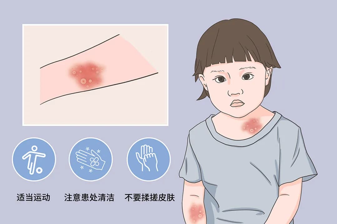 扁平疣：皮肤的“小麻烦”，你了解多少？