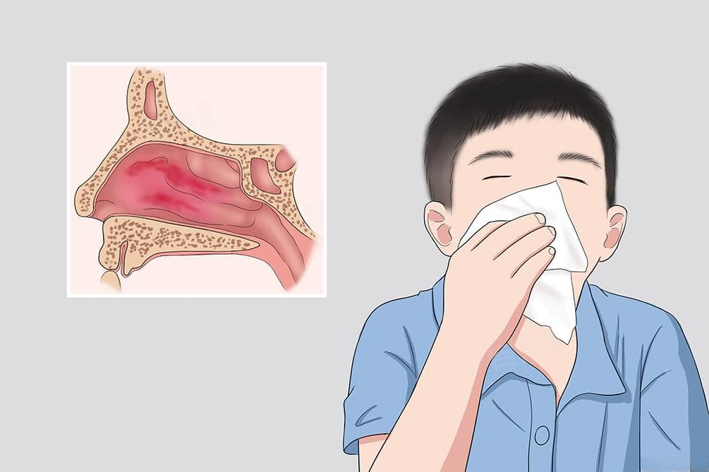 鼻炎怎么得上的？一文详解鼻炎成因与治疗方法