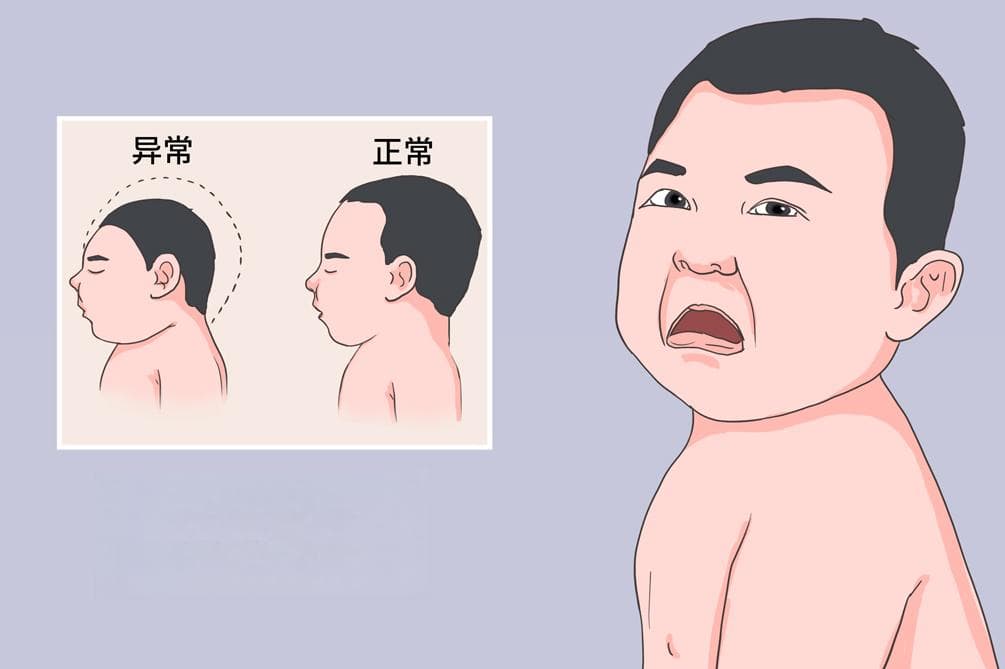 小头畸形：症状、诊断与治疗全解析