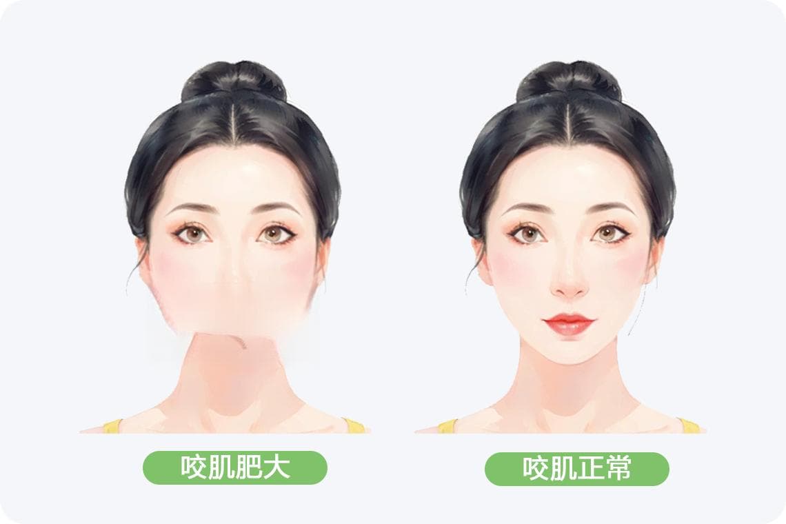 咬肌发达怎么改善