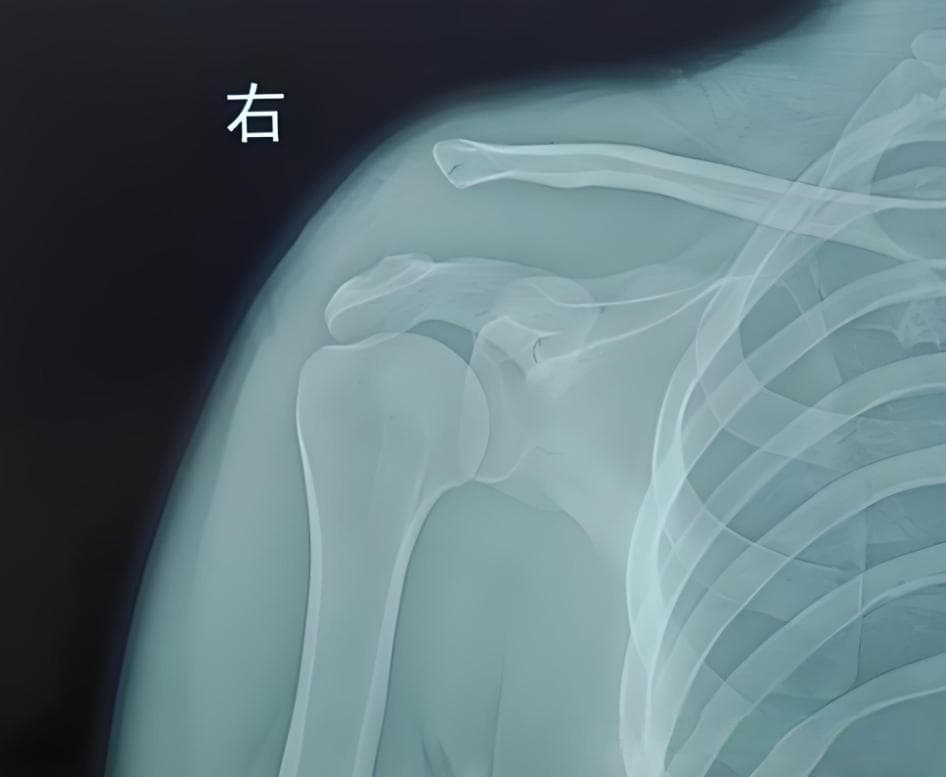 【盘点】肩关节疼痛常见的 7 种疾病