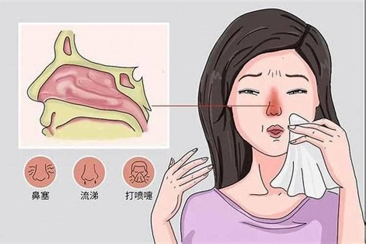 专家分享：鼻窦炎不及时治疗会有哪些危害？