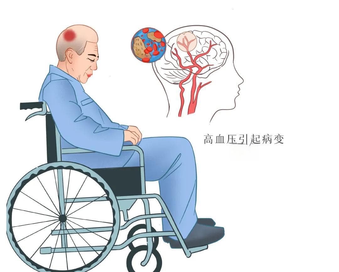 卒中科普 | 脑卒中的危险因素及干预！