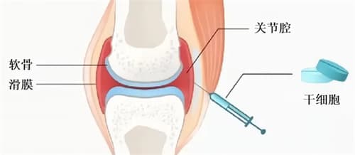 膝盖关节炎患者必看：干细胞治疗费用详细解析，真实病例告诉你是否可以选择！