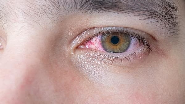 糖尿病视网膜眼底病变的分期与治疗