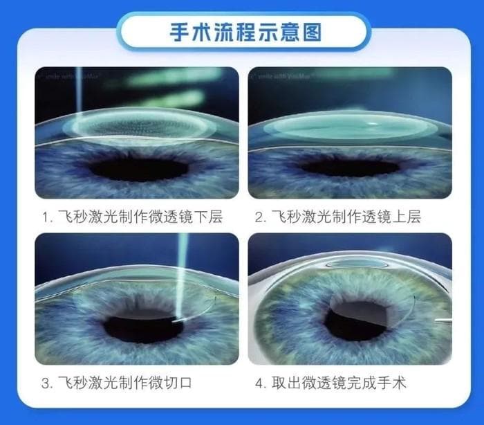 暑期摘镜总动员|近视手术术后，我的视力能恢复到多少？
