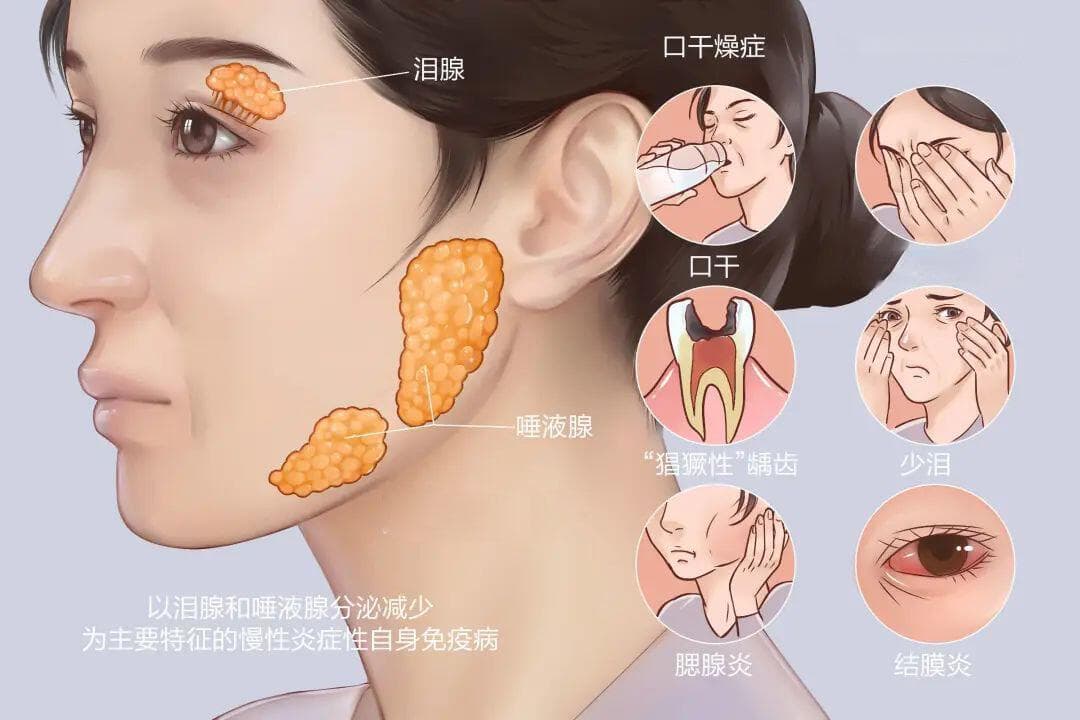 口腔干燥综合征，你了解多少？