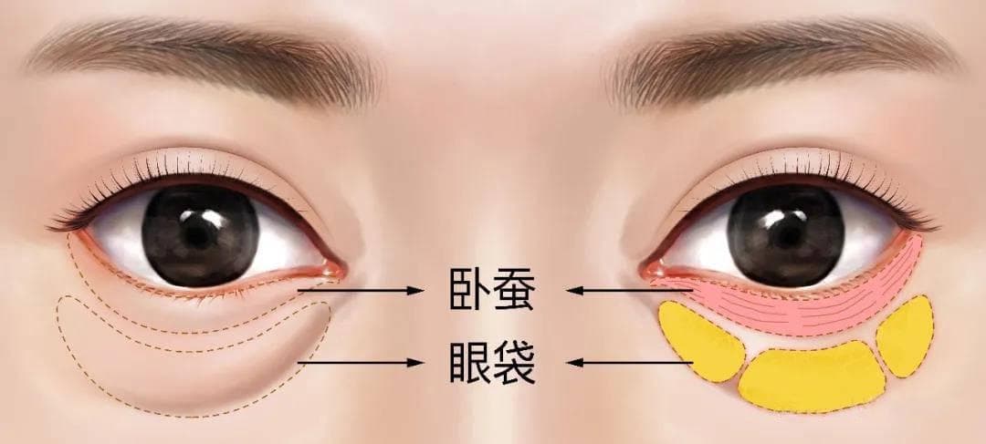 微整医生胡可：探讨卧蚕的形成机制及对面部的影响