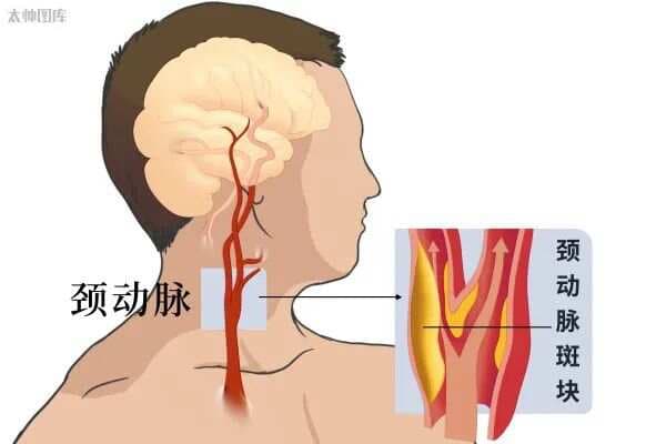 首次发现：动脉粥样斑块竟能完全消退！不过需满足4个条件