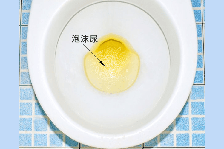 上完厕所不妨低头看一眼：尿液泡沫多，可能预示这4个健康问题